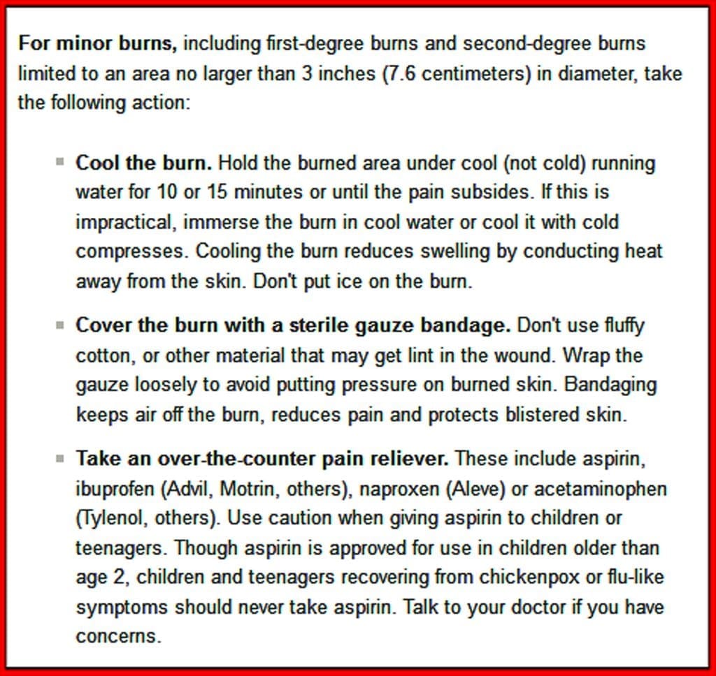 علاج الحروق بدون الدقيق